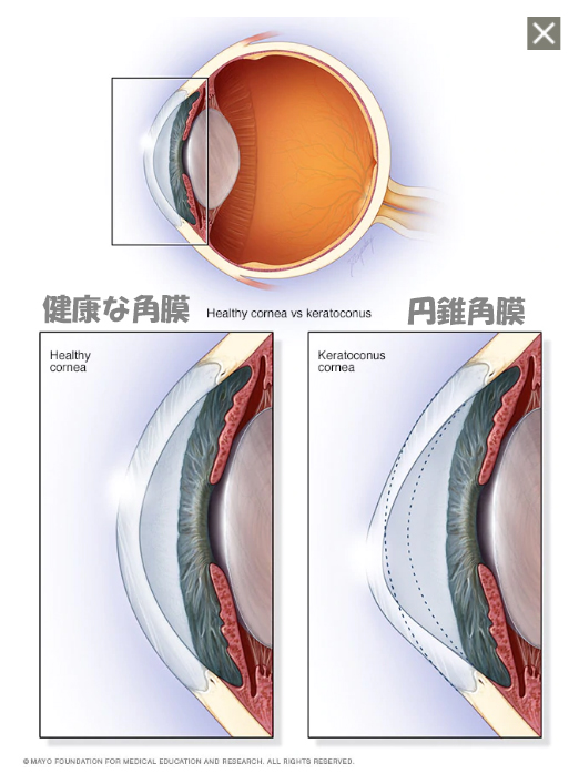 円錐角膜で運転免許を取得 更新することはできるのか にぃもブログ